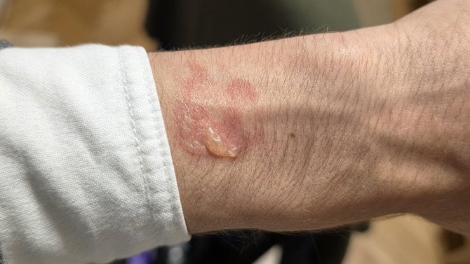 Varování pro majitele Samsung Galaxy Watch: Hodinky se mohou kvůli chybě přehřát a způsobit puchýře